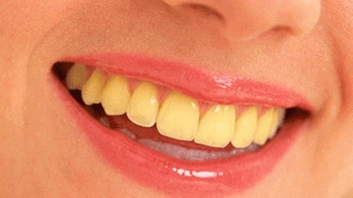 Tips Serta Pentingnya Scalling Gigi Saat Puasa