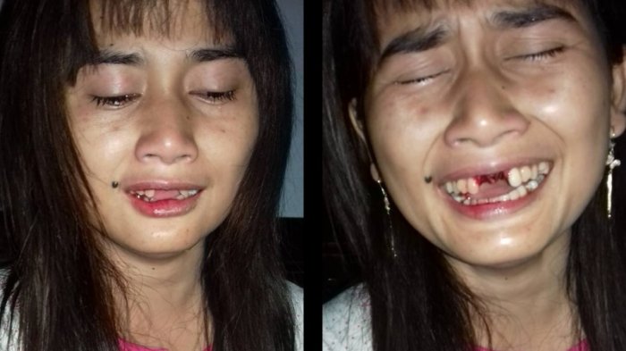 Miris! Mulut Wanita Muda Ini Ditendang Sang Suami Hingga Giginya Rontok, Ini Curhatannya
