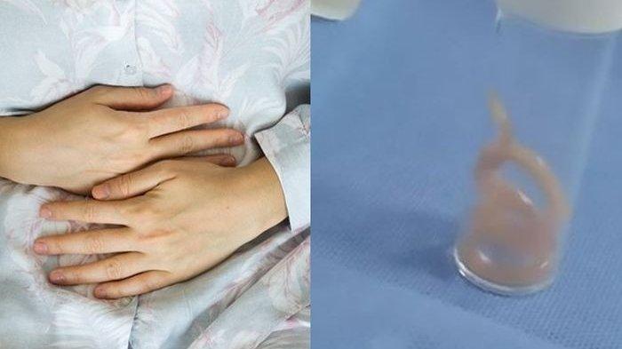Ngeri, Mengeluh Sakit Perut 10 Tahun Ternyata di Dalam Perut Wanita Ini Ada Hewan Melata Bersarang
