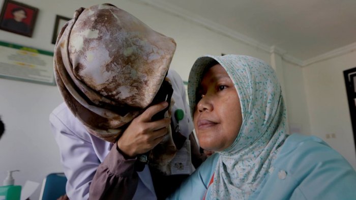 Peringati World Glaucoma Week, RS Mata Dr YAP Gelar Pemeriksaan Glaukoma Gratis