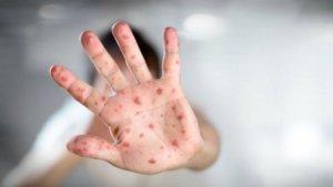 WASPADA-Penyakit-Cacar-Monyet-atau-Monkeypox-yang-Jadi-Perhatian-WHO-Ini-Bedanya-dengan-Covid-19.jpg