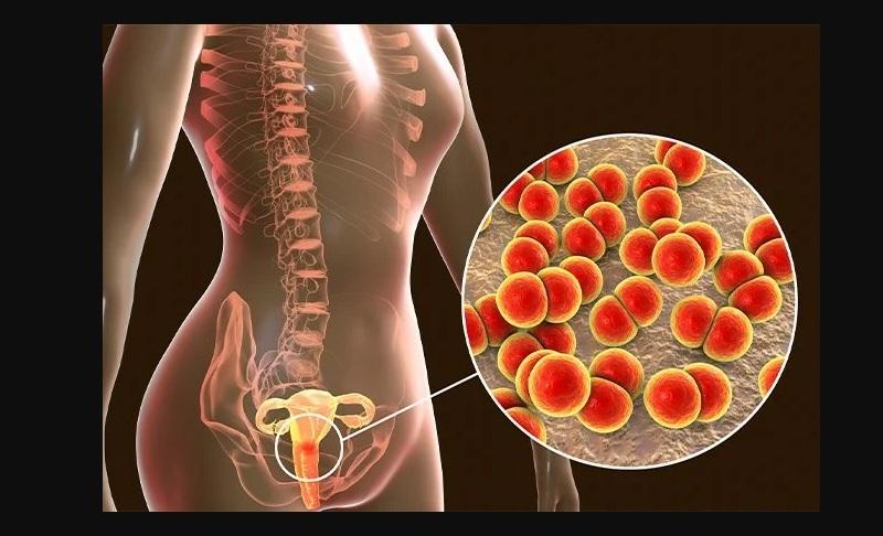 Perhatikan! Ini Gejala Awal Penyakit Kencing Nanah pada Pria dan Wanita