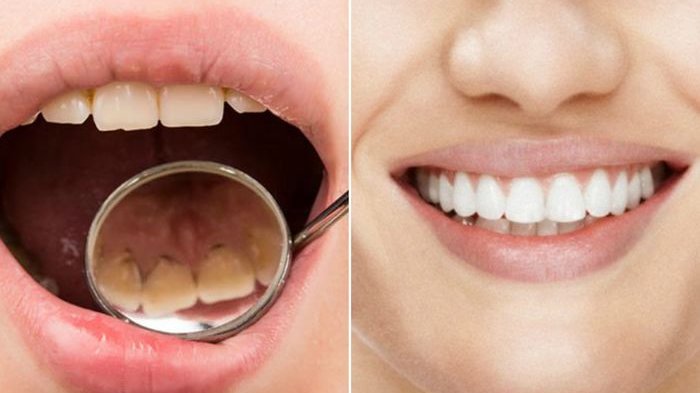 tips-menghilangkn-plak-gigi_20180830_124910.jpg