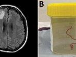 Cacing-Parasit-Hidup-di-Otak-Manusia.jpg