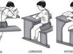 Perbedaan-Lordosis-Kifosis-dan-Skoliosis-Lengkap-dengan-Metode-Mudah-Menghafal.jpg