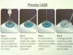 lasik_20170908_160116.jpg
