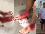 sam-kanizay-remaja-australia-yang-menjadi-korban-kutu-laut-pemakan-daging_20170813_193333.jpg