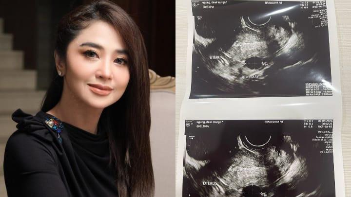 Tak Terima Digosipkan Mandul, Dewi Perssik Tunjukkan Foto USG dan Singgung Hukum Tabur Tuai