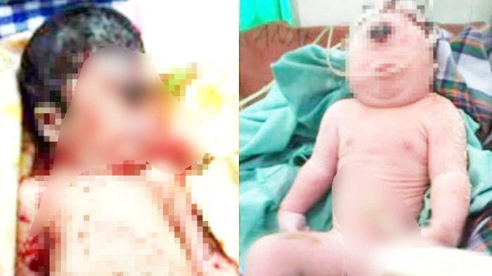 5 Fakta Bayi Lahir Mata Satu dan Tanpa Hidung di Mandailing Natal