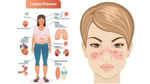 Hari-Lupus-Sedunia-2023.jpg