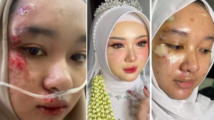 Viral MUA Balikpapan Sukses Rias Pengantin Wanita yang Wajahnya Penuh Luka Usai Kecelakaan H-3 Nikah