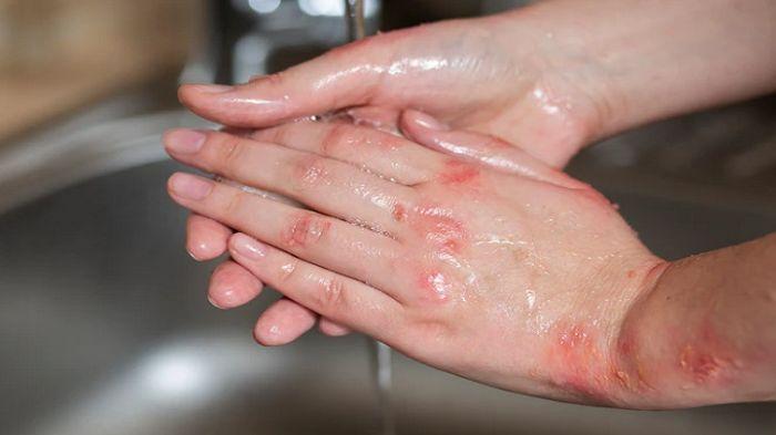 Kusta Bukan Penyakit Kutukan, Bisa Sembuh Total dan Obatnya Gratis - Tribunkaltim.co
