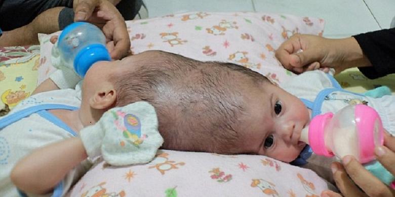 Kembar Tiga, Dua Bayi Lahir dengan Kepala Menyatu