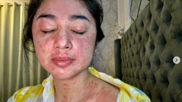 Gejala Langka Virus Corona, Dewi Perssik Positif Covid-19, Seluruh Kulit Tubuhnya Muncul Ruam Merah