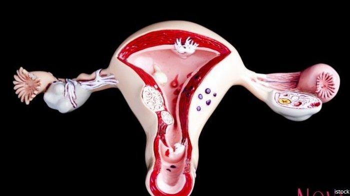 5 Tanda Kanda Serviks yang Perlu Diwaspadai Serta Cara Mencegahnya