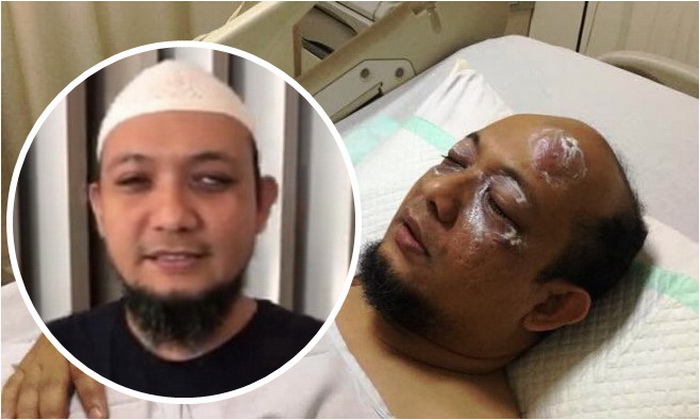 Dioperasi, Kornea Mata Kiri Novel Baswedan Dibuat dari Gigi