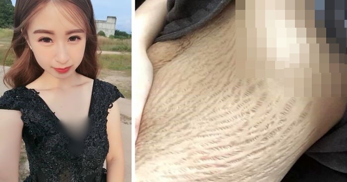 Banyak yang Menghujat Bekas Stretch Marks di Perutnya, Postingan Wanita Ini Justru Menginspirasi