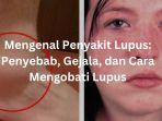 Lupus-adalah.jpg