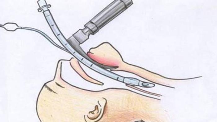 Ilustrasi anastesi 1