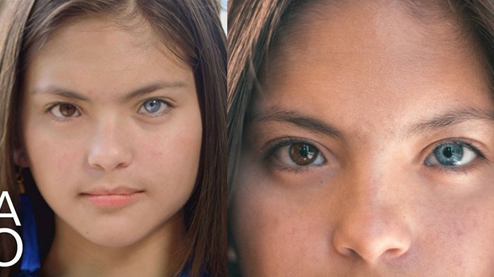 Wow! Gadis 14 Tahun Ini Miliki Dua Warna Mata yang Berbeda
