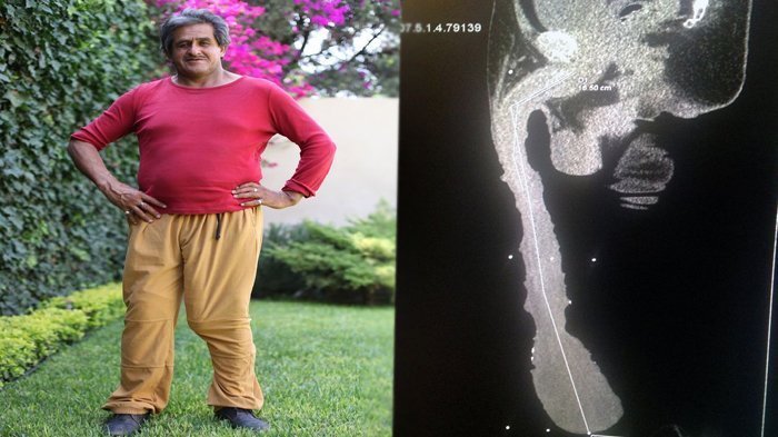 Pria Pemilik Organ Intim Terpanjang dan Terbesar Ini Mengaku Tersiksa
