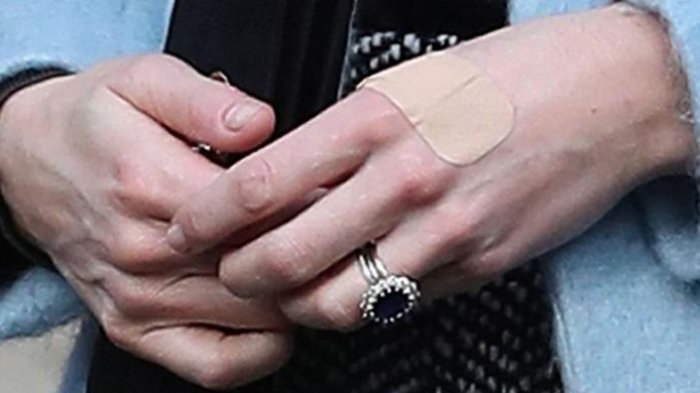 Ini Alasannya, Mengapa Tangan Kate Middleton Sering Terluka