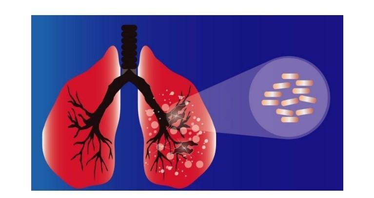 TBC Menjadi Penyebab Utama Kematian Akibat Penyakit Menular pada Tahun 2023