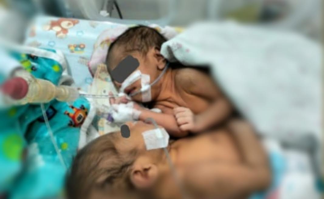 bayi-kembar-siam-lahir-di-rsud-dr-hendrikus-fernandez-larantuka-flores-timur.jpg