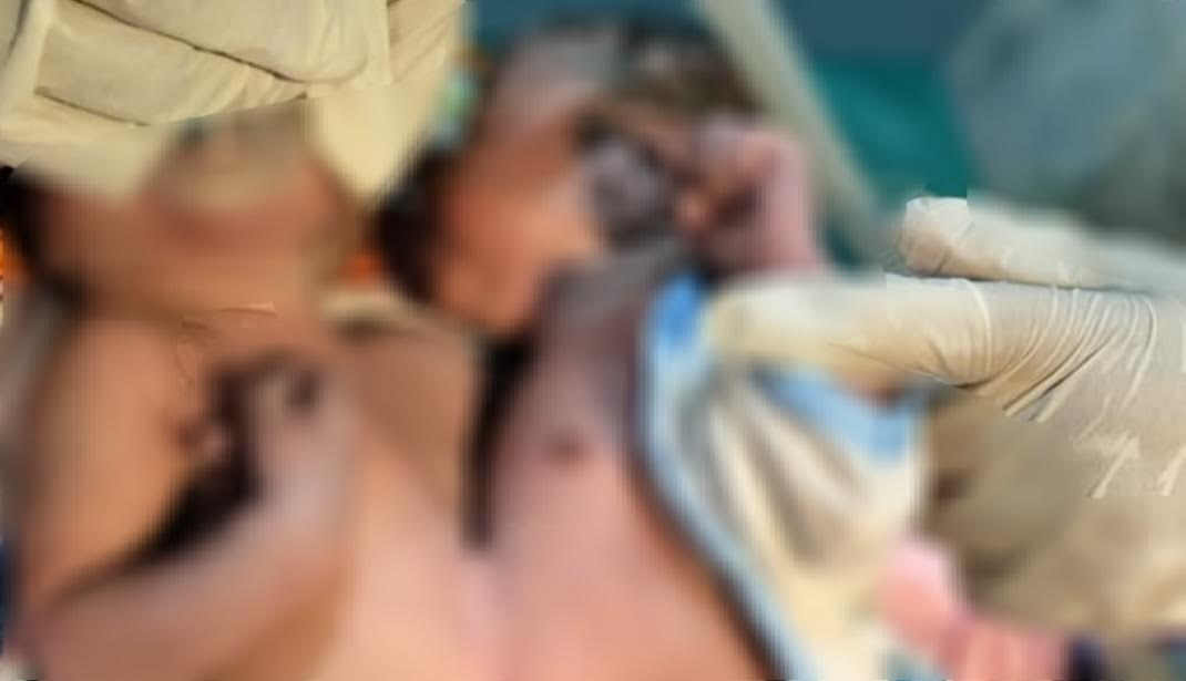 Bayi Kembar Siam Lahir di RSUD Larantuka Flores Timur, Begini Kondisinya