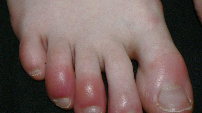 Wajib Tahu,5 Kondisi Kulit yang Dikaitkan sebagai Gejala Virus Corona, Begini Penjelasan Medisnya