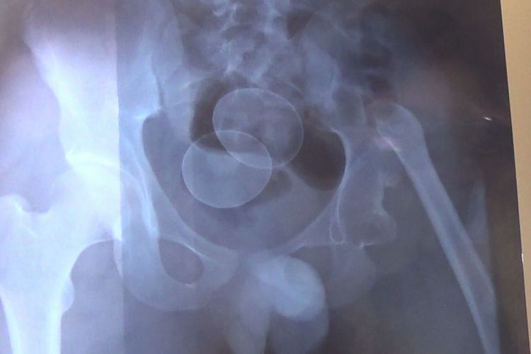 Dua Tahun Lalu Remaja Ini Bertelur Sembilan Butir, Kini Kembali Dibawa ke Rumah Sakit, Ini Buktinya!