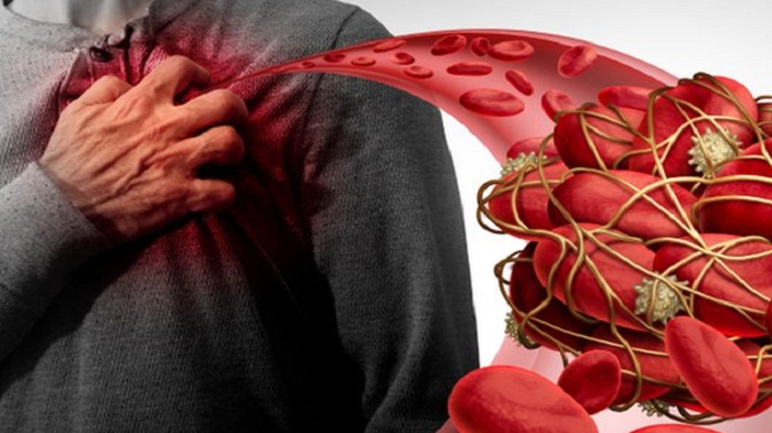 Pengentalan Darah Bisa di 5 Tempat, Gejala Penyakit Pengentalan Darah Mual Jantung Berdebar Tajam