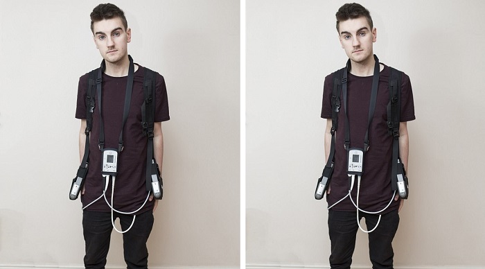 Jantungnya Membesar, Pria Ini Harus Mengisi Ulang Dirinya Menggunakan Listrik agar Bertahan Hidup