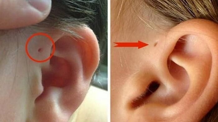 JANGAN KAGET! Punya Lubang Kecil di Atas Daun Telinga? Ini Penjelasan Tanda Tak Dimiliki Semua Orang
