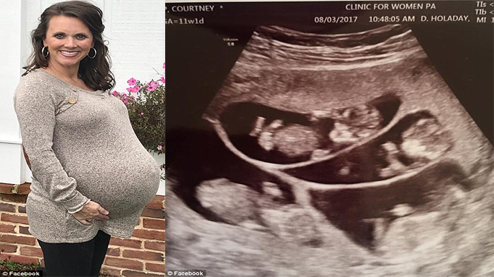 Pernah Alami Keguguran, Tak Disangka Wanita Ini Mengandung 6 Anak Kembar, Begini Kondisi Anaknya