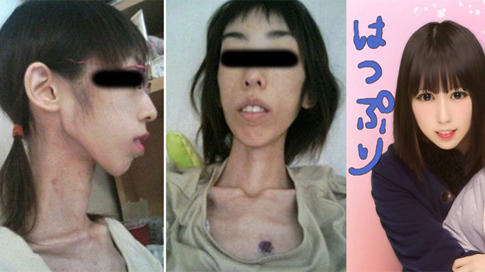 Dibiarkan Kelaparan oleh Kakeknya, Wanita Jepang Ini Hanya Memiliki Berat Badan 16 Kg!