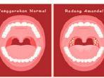 Gambar-Tenggorokan-Normal-dan-Radang-Amandel.jpg