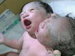 bayi-berkepala-dua_20160915_192745.jpg
