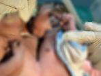 bayi-kembar-siam-lahir-di-rsud-dr-hendrikus-fernandez-larantuka.jpg