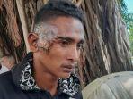pelipis-kanan-yoseph-terbakar-terkena-knalpot-panas.jpg
