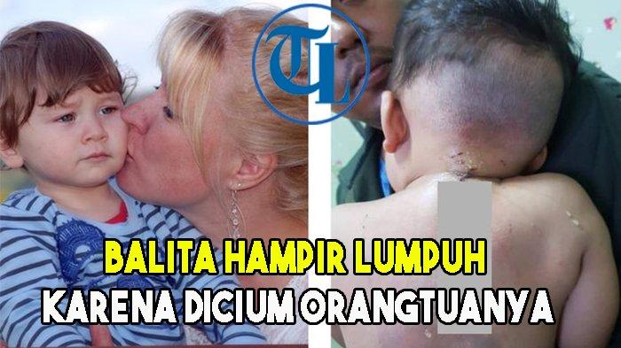 Balita Hampir Lumpuh karena Dicium Orangtuanya