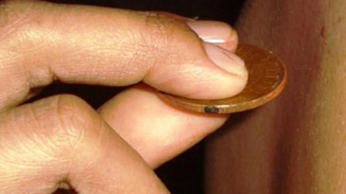 Mengapa Kerokan Bisa Membuat Relaksasi dan Ketagihan? Sains Menjawabnya