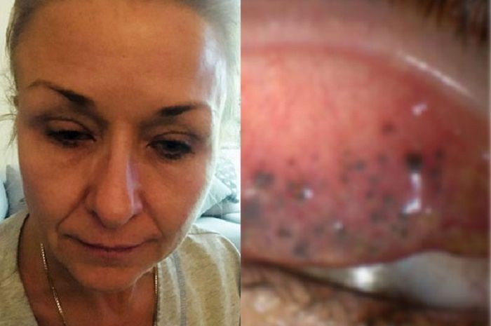 25 Tahun Tak Bersihkan Maskara dengan Baik, Kelopak Mata Wanita Ini Berubah Mengerikan