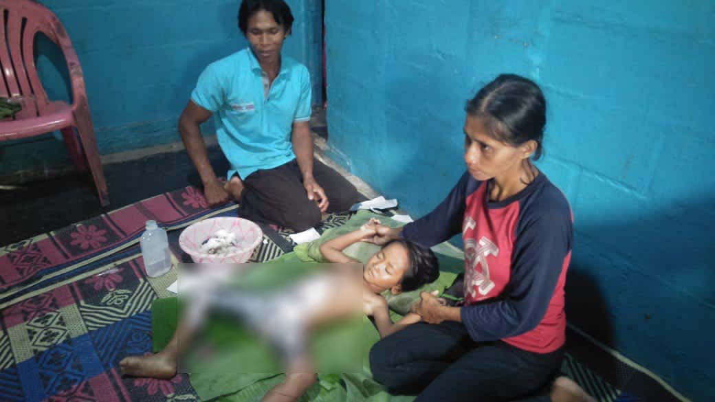 Alami Luka Bakar Akibat Bermain Korek Api, Bocah Asal Kota Alam Lampung Utara Butuh Bantuan