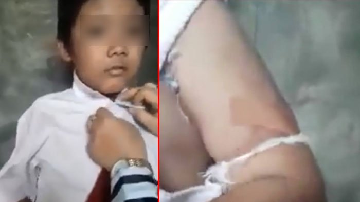 Guru Curiga Lihat Mata Muridnya Menghitam, Saat Dibuka Bajunya Buat Tak Percaya