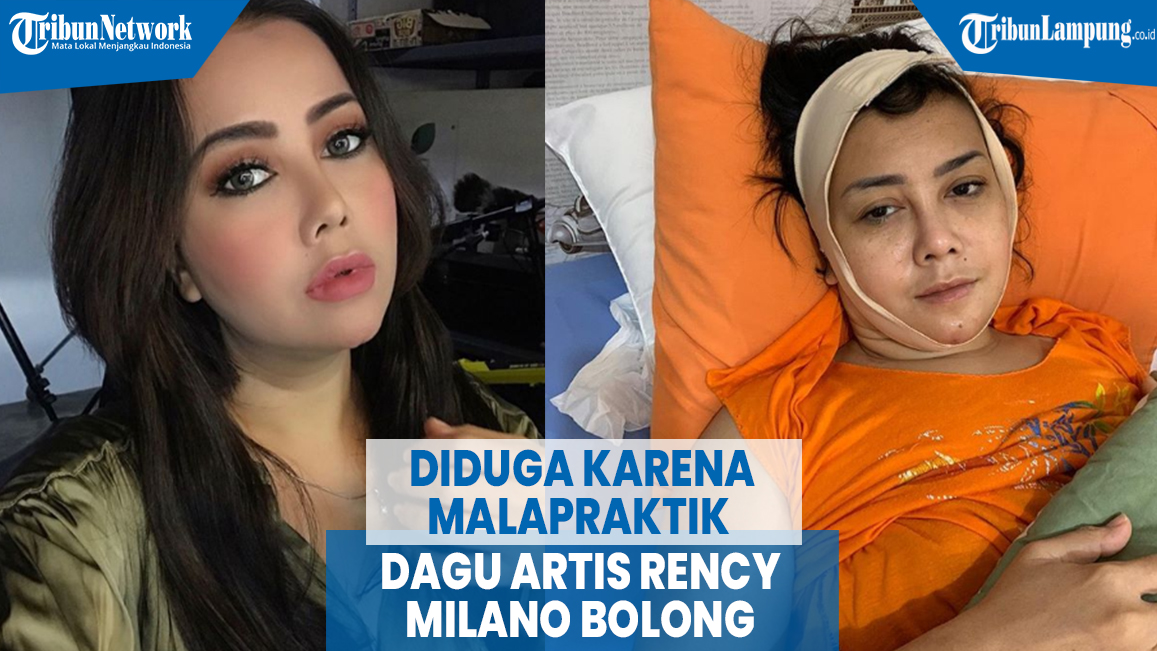 VIDEO Diduga karena Malapraktik Dagu Artis Rency Milano Bolong