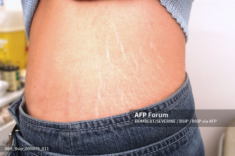 halo-dokter-penjelasan-apa-itu-stretch-mark.jpg