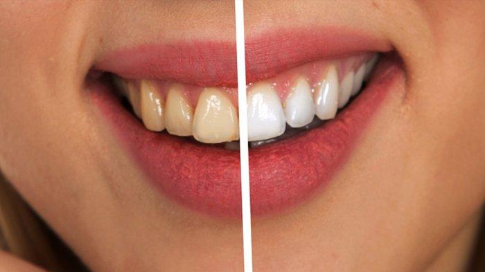 halo-dokter-penyebab-gigi-kuning-dan-cara-mengatasinya.jpg