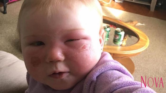 Fatal Akibatnya, Jangan Sembarangan Memberikan Tabir Surya ke Bayi