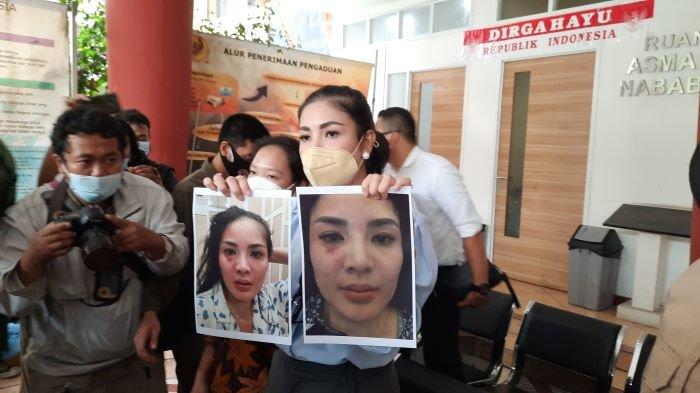 Artis Nindy Ayunda Tunjukkan Foto KDRT yang Dilakukan Askara Parasady Harsono